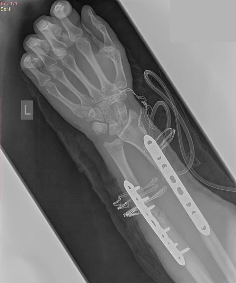 Taping – plastrowanie